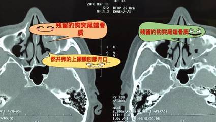 螺紋安全套小包裝